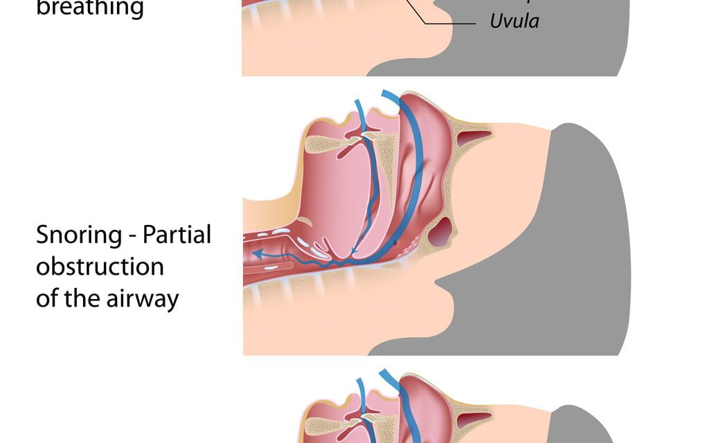 What Causes Sleep Apnea ?