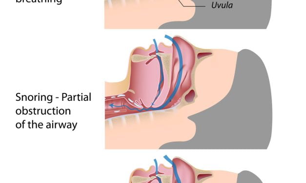 What Causes Sleep Apnea ?